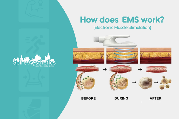 EMS treatment for post pregnancy weight loss treatment Lancaster