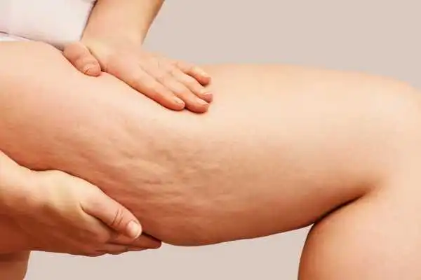 Image of woman showing leg with cellulite Lancaster