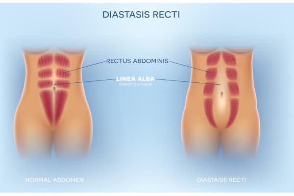 How Does Non-Surgical Treatment Help With Loose Skin, Weak Abdominal Muscles and Post-Pregnancy Changes Lancaster?
