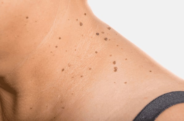 Are you looking for easy skin tag removal Lancaster - then contact Spire today!