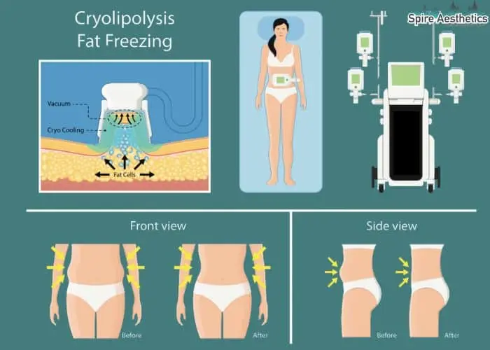 Fat freezing treatment Lancaster benefits for competitions to remove stubborn fat deposits.