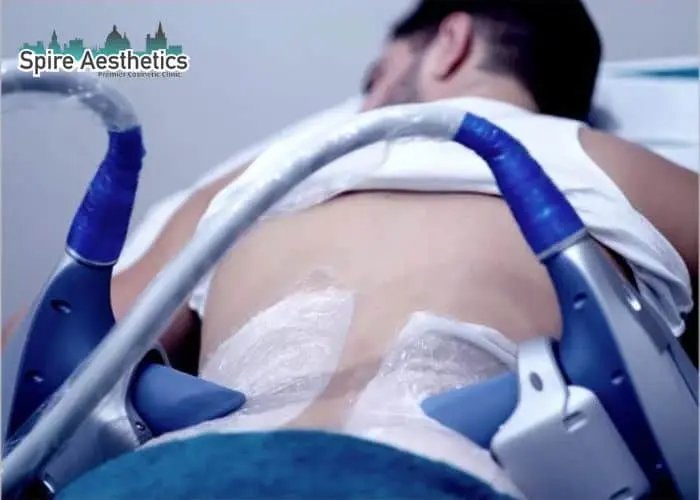 Man having fat freezing treatment done on love handles before a competitions Lancaster to create a sculpted look.