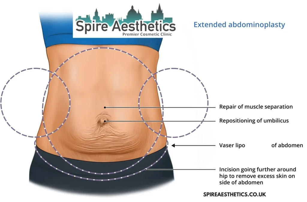 Understanding Loose Skin After Gastric Band Lancaster Surgery and HIFU Treatment
