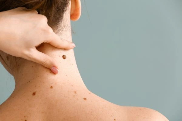 skin blemish removal Lancaster treatment