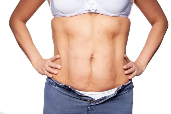sagging skin on woman's stomach after weight loss injections Lancaster