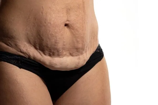 Image of womans stomach after weight loss injections Lancaster showing saggy skin