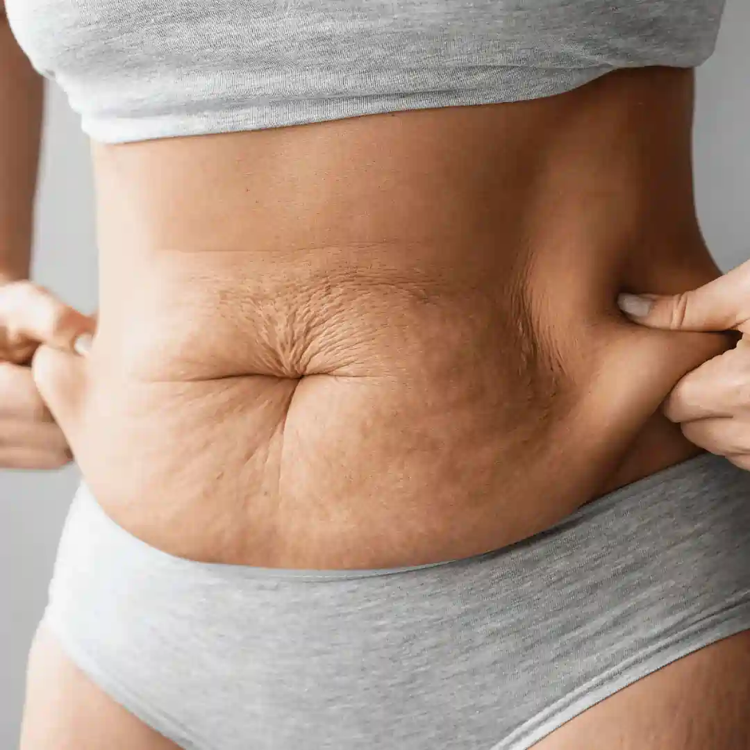 Is It Normal to Have Loose Skin After Pregnancy Lancaster?