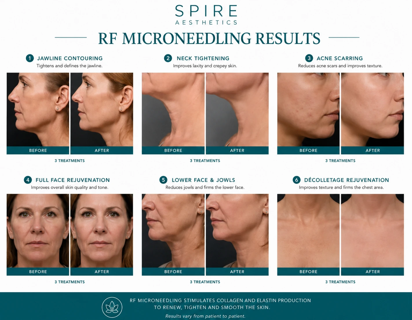 RF Microneedling Skin tightening Lancaster results