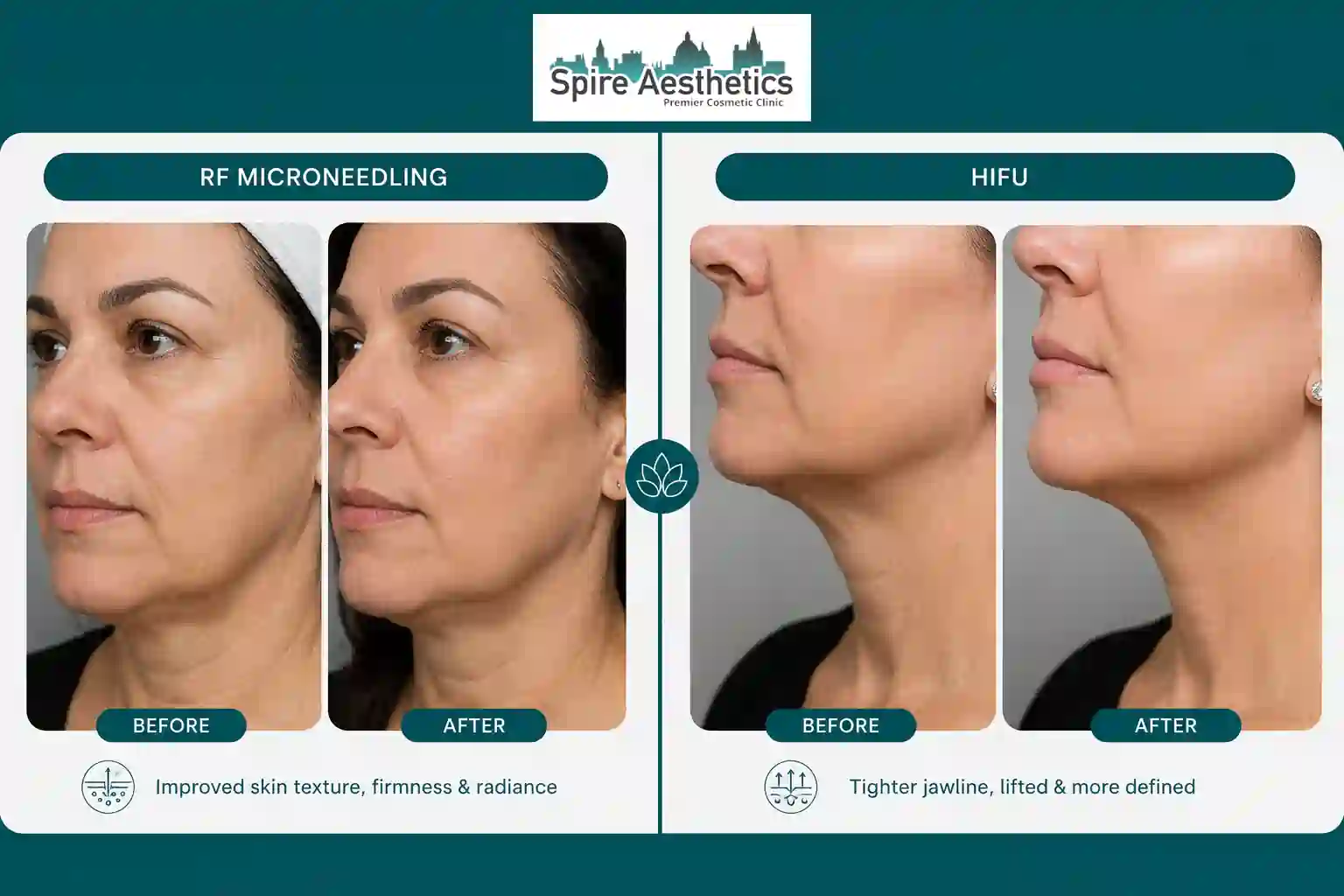 Can RF Microneedling and HIFU Be Combined Lancaster?
