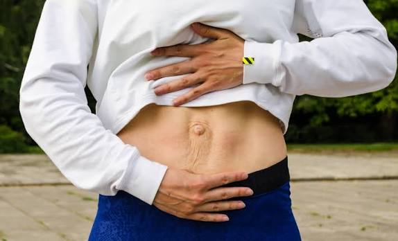 When Could Diastasis Recti Be the Missing Piece of the Puzzle Lancaster?