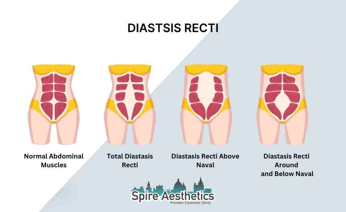 Is Non-Surgical Diastasis Recti Treatment Right for You? Common Concerns Answered Lancaster